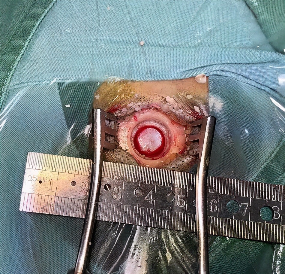 先后成功完成了脑室镜下三脑室底造瘘术,脑室内脉络丛电灼术,术中近乎