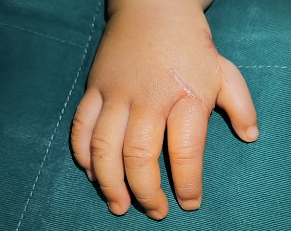 宝宝拇指先天性发育不良漂浮拇,还能保五指吗?