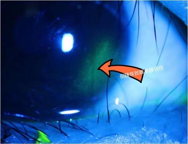 女童角膜上皮擦伤竟是因为睫毛倒着长医生提醒倒睫非小事家长应重视