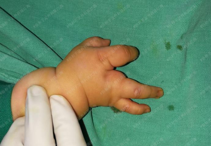 手掌裂成了两半分裂手孩子有救吗