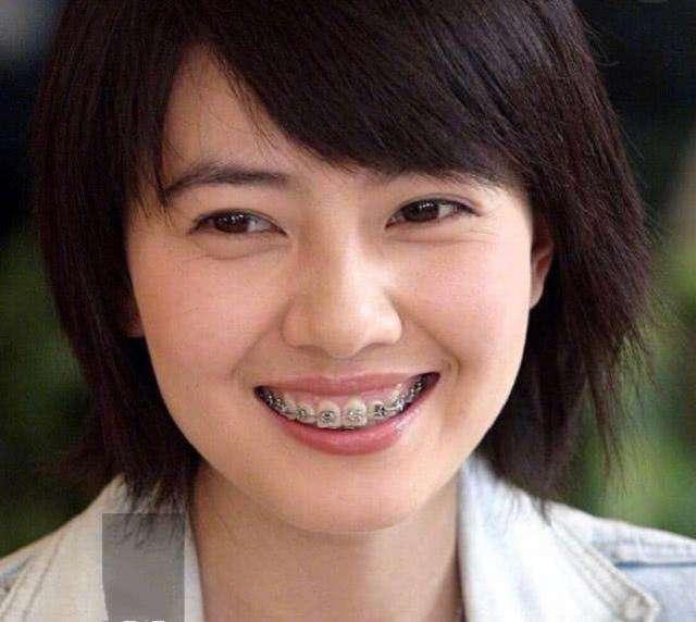 明星整牙堪比整容,高圆圆笑得好看全靠牙,蔡徐坤胡歌似变了个人