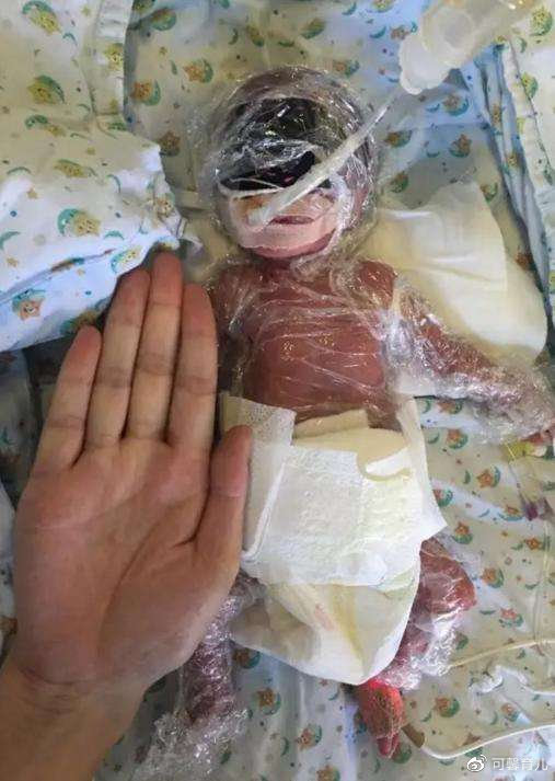 被抢救了三个多月的双胞胎早产儿,终于可以回家了.