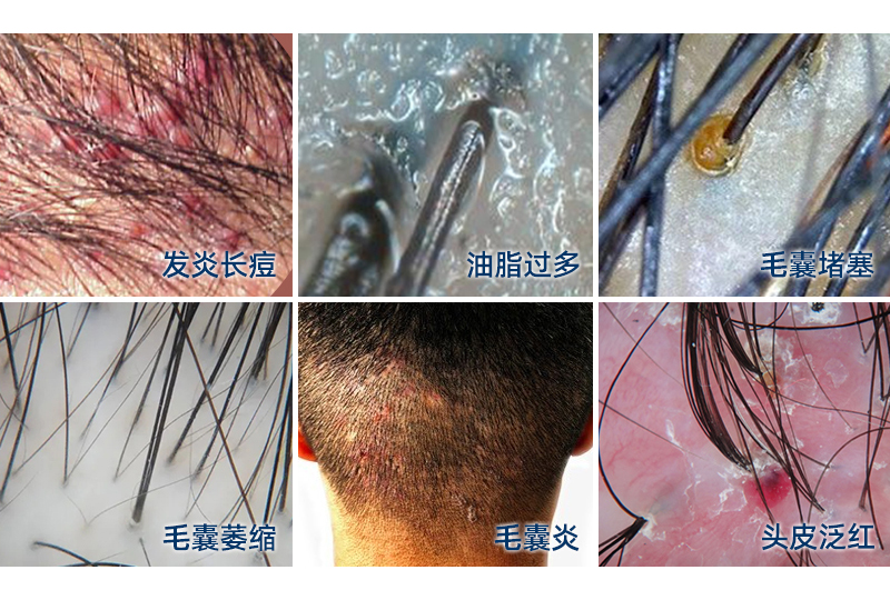 头皮油垢堆积堵塞毛孔,细菌感染发炎,就形成了头皮毛囊炎