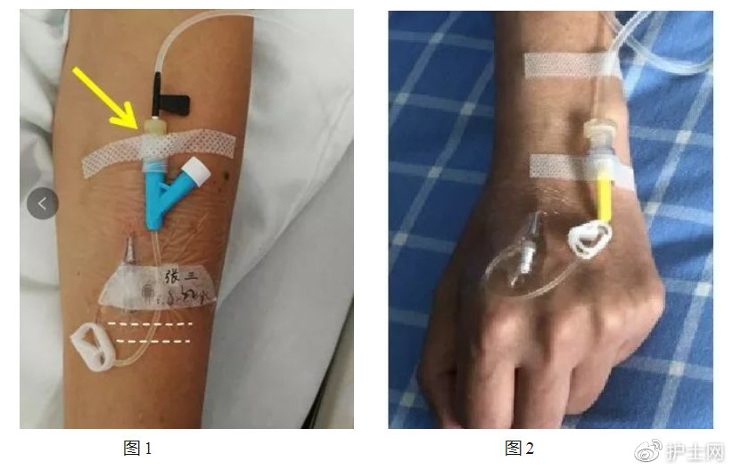 护士,留置针这样固定可能有问题!