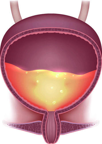 此外膀胱炎症会影响膀胱括约肌,也会引发尿急,尿频,导致患者出现夜尿