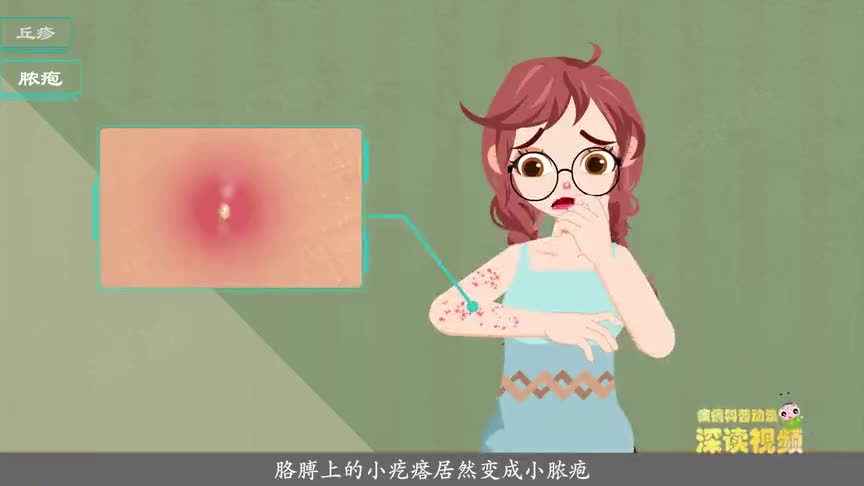 身上长痘痘是毛囊炎科普动漫毛囊炎告诉你哪里的痘痘不能挤