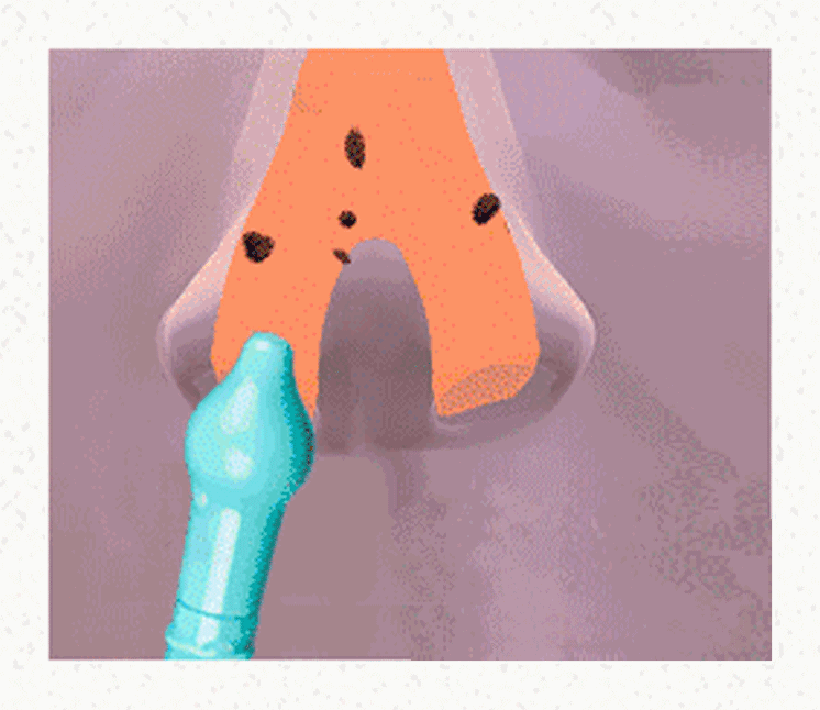 不同浓度的生理盐水作用不同不是所有的生理盐水都能用来洗鼻1.