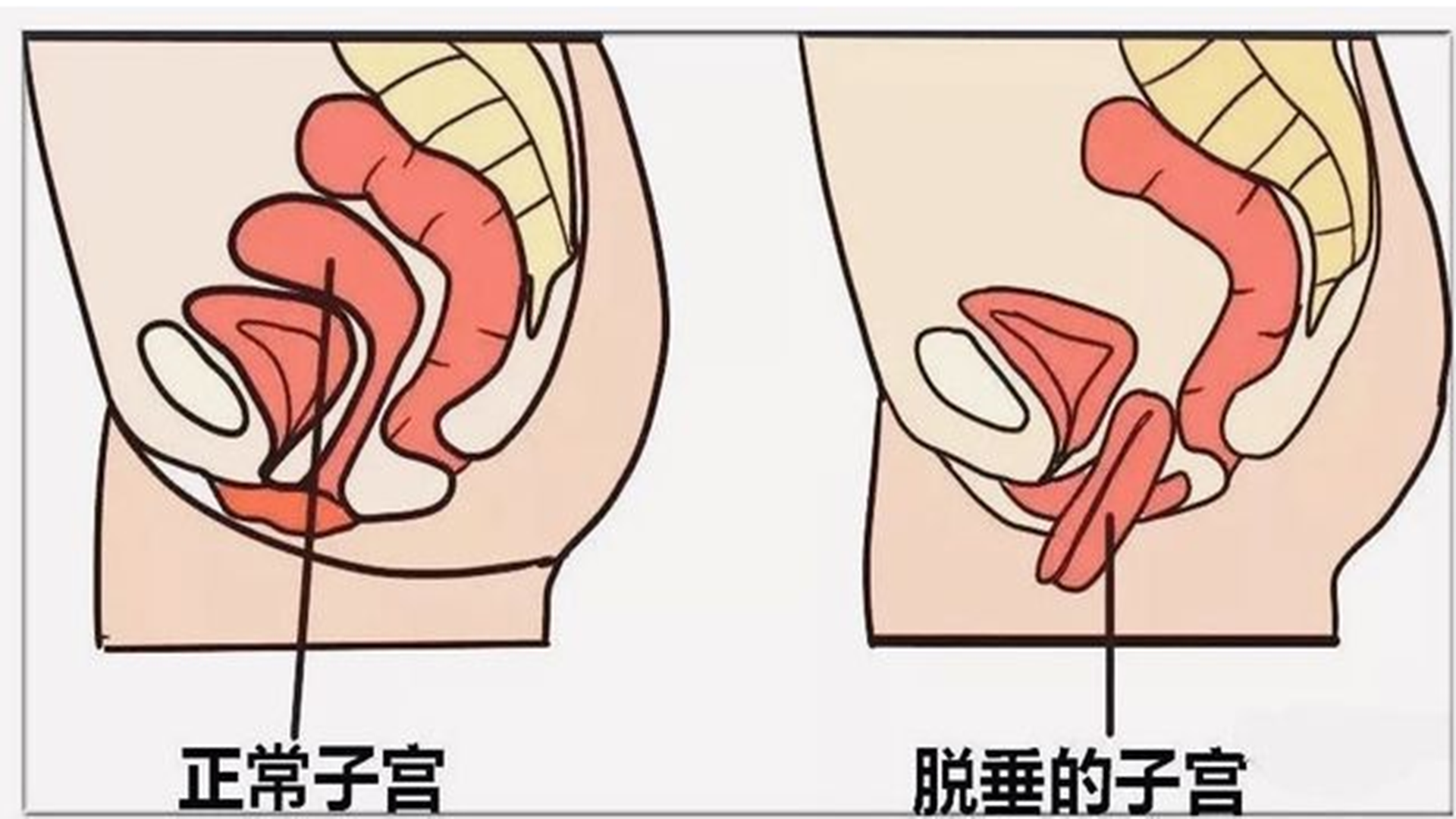 第二:子宫下垂,终身不能治愈.第三:大出血,半只脚踏进了太平间.