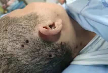 头部被马蜂蛰伤47处命悬一线,成医附院医生为她两次"换血"救命|女士