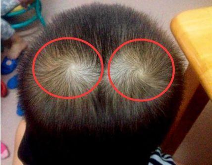 孩子头顶有"2个旋"代表什么?和性格,智商有关吗?家长要清楚