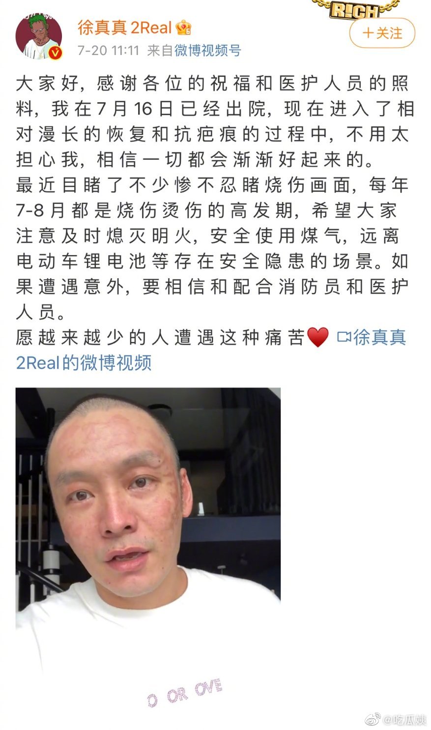 之前因为未熄灭蜡烛的而被烧伤的音乐人徐真真