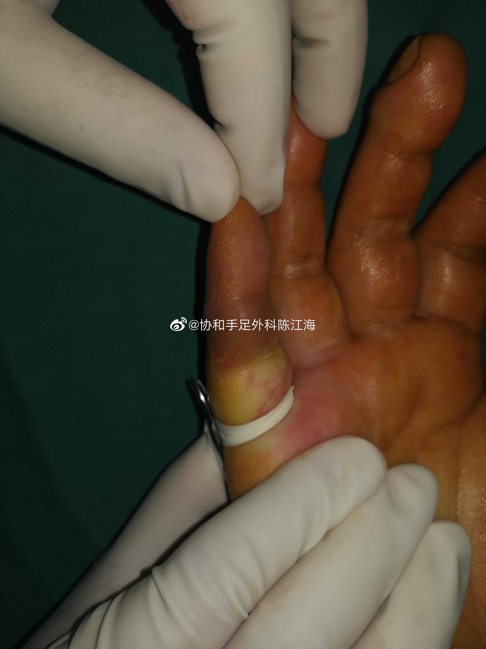 昨天做的一个小手术是切除一个腱鞘巨细胞瘤