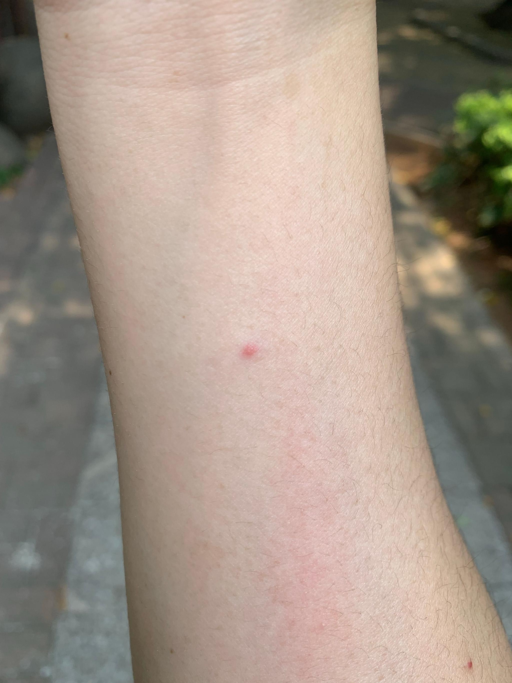 被毒蚊子咬后如何快速消肿止痒？