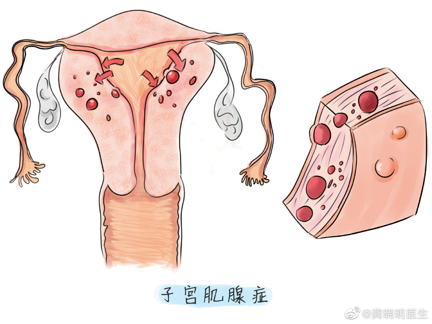 超声报告上经常写"子宫腺肌瘤"_高清图集_新浪网