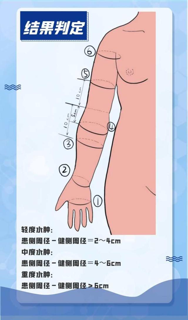乳腺癌术后,她上肢水肿、皮肤变粗……医生提醒,这些患者,到了夏天要格外注意休闲区蓝鸢梦想 - Www.slyday.coM 乳腺癌术后,她上肢水肿、皮肤变粗……医生提醒,这些患者,到了夏天要格外注意休闲区蓝鸢梦想 - Www.slyday.coM