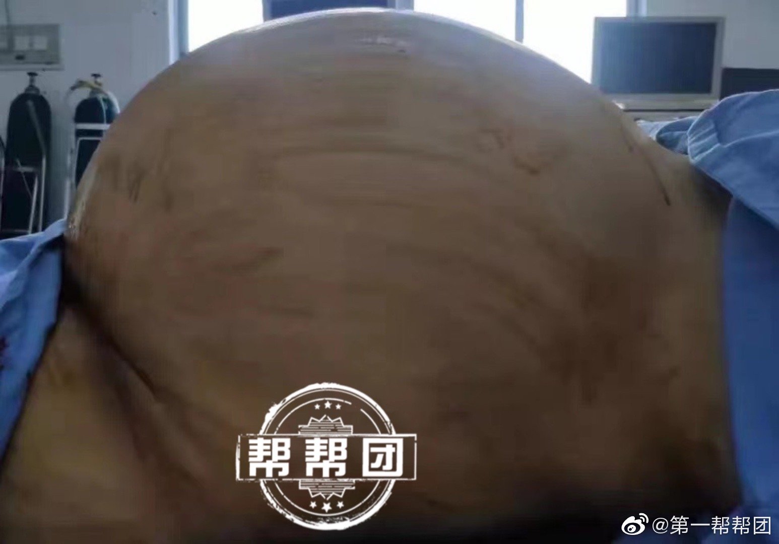 腹大如多胎足月孕妇,年轻女子腹藏巨大肿瘤