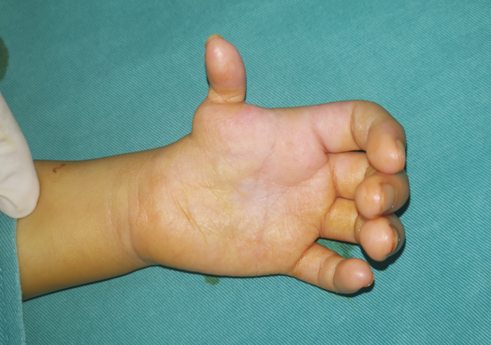 拇指发育不良漂浮指重塑手术让孩子更早地建立拇指功能