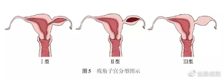 宫角妊娠解剖图片