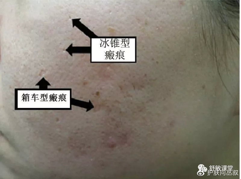 痤疮瘢痕的分型及治疗|瘢痕疙瘩|瘢痕|痤疮_新浪新闻