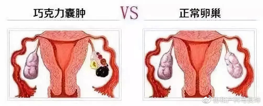 必然造成恶劣影响:卵巢皮质受侵,卵巢功能下降,子宫和卵巢间唯一的