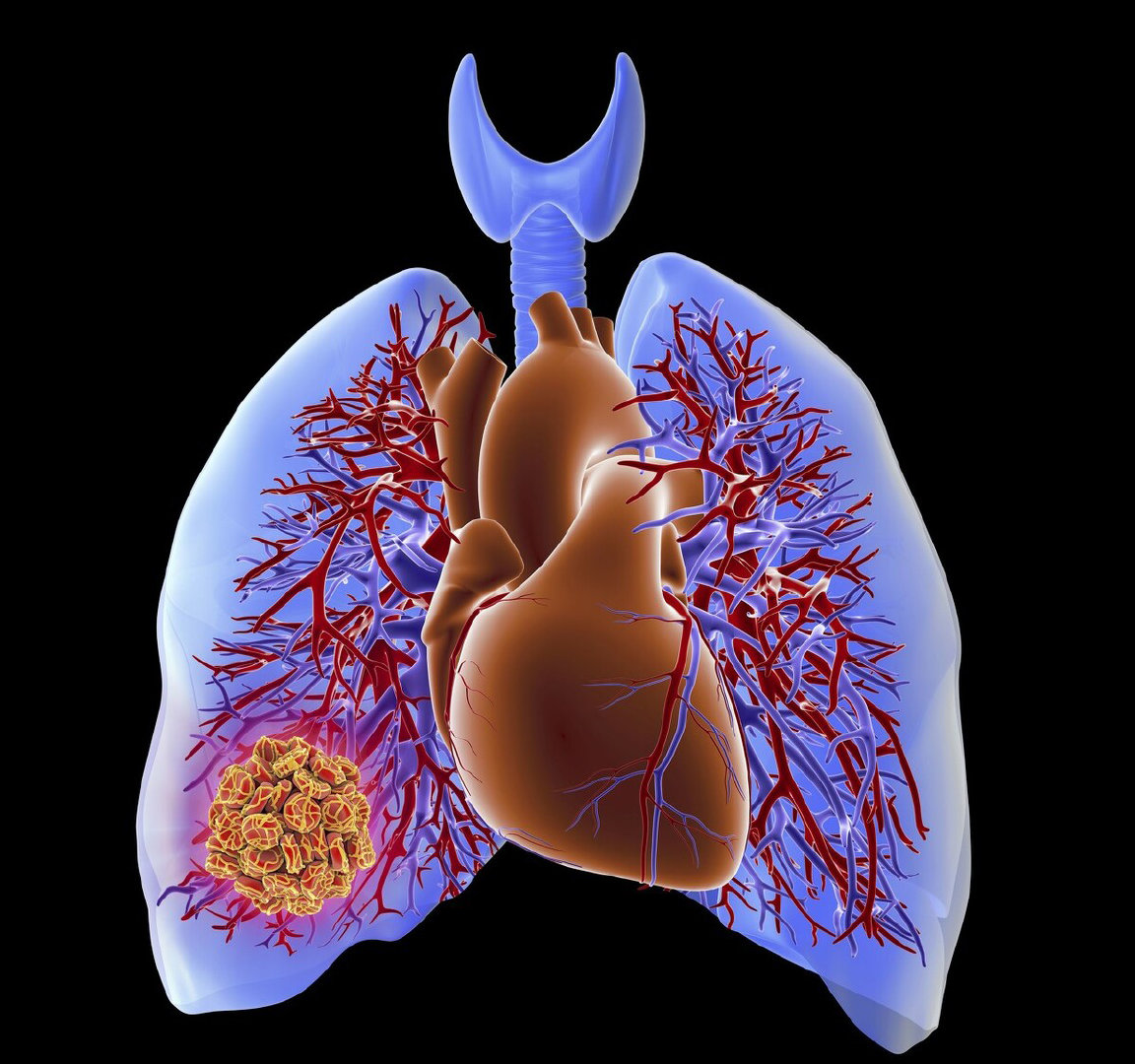病人血管里游走的"核潜艇"从腿游到了肺,医生看完片子告了病危