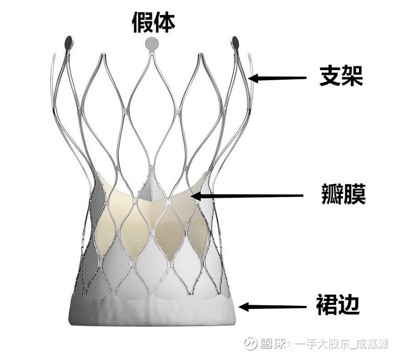 心脏支架能放几个 心脏支架手术最多能放几个