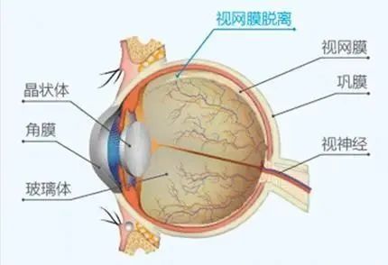 男子躺床玩手機砸眼致視網膜脫落,高度近視是大誘因?快來檢查!