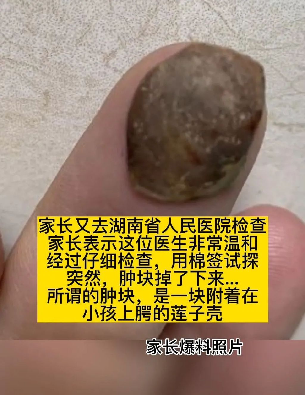 孩子嘴里出现肿块:湘雅医院诊断肿瘤,省医院棉签一拨去掉莲子壳休闲区蓝鸢梦想 - Www.slyday.coM 孩子嘴里出现肿块:湘雅医院诊断肿瘤,省医院棉签一拨去掉莲子壳休闲区蓝鸢梦想 - Www.slyday.coM