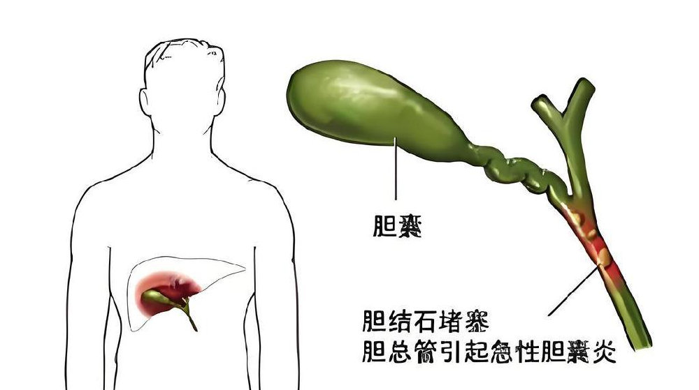 胆结石人,入伏三杯“排石饮”,配方放这里,疏肝利胆,化掉结石|胆囊|鸡内金|金钱草|玉米须|胆汁_新浪新闻