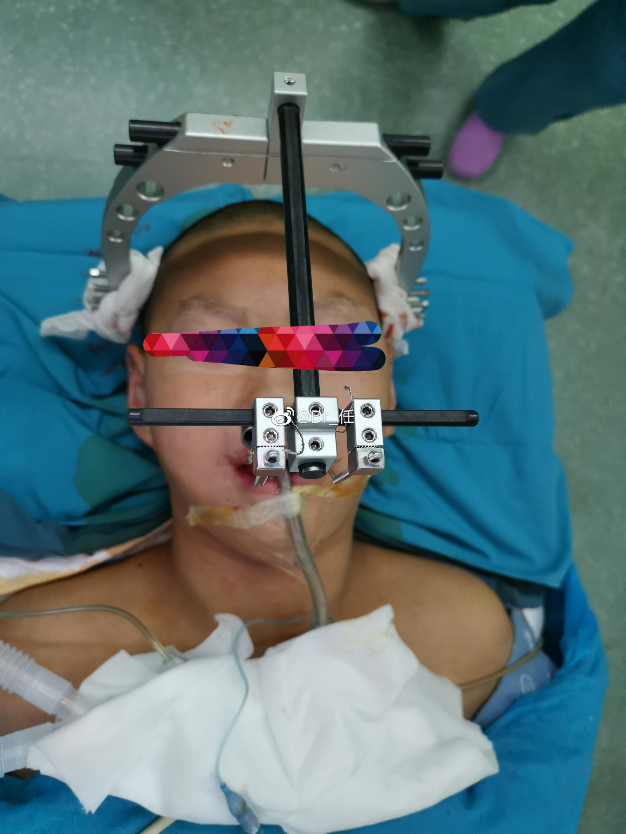 青岛妇儿口腔颌面外科省内第一例上颌骨牵引器置入治疗发育期上颌
