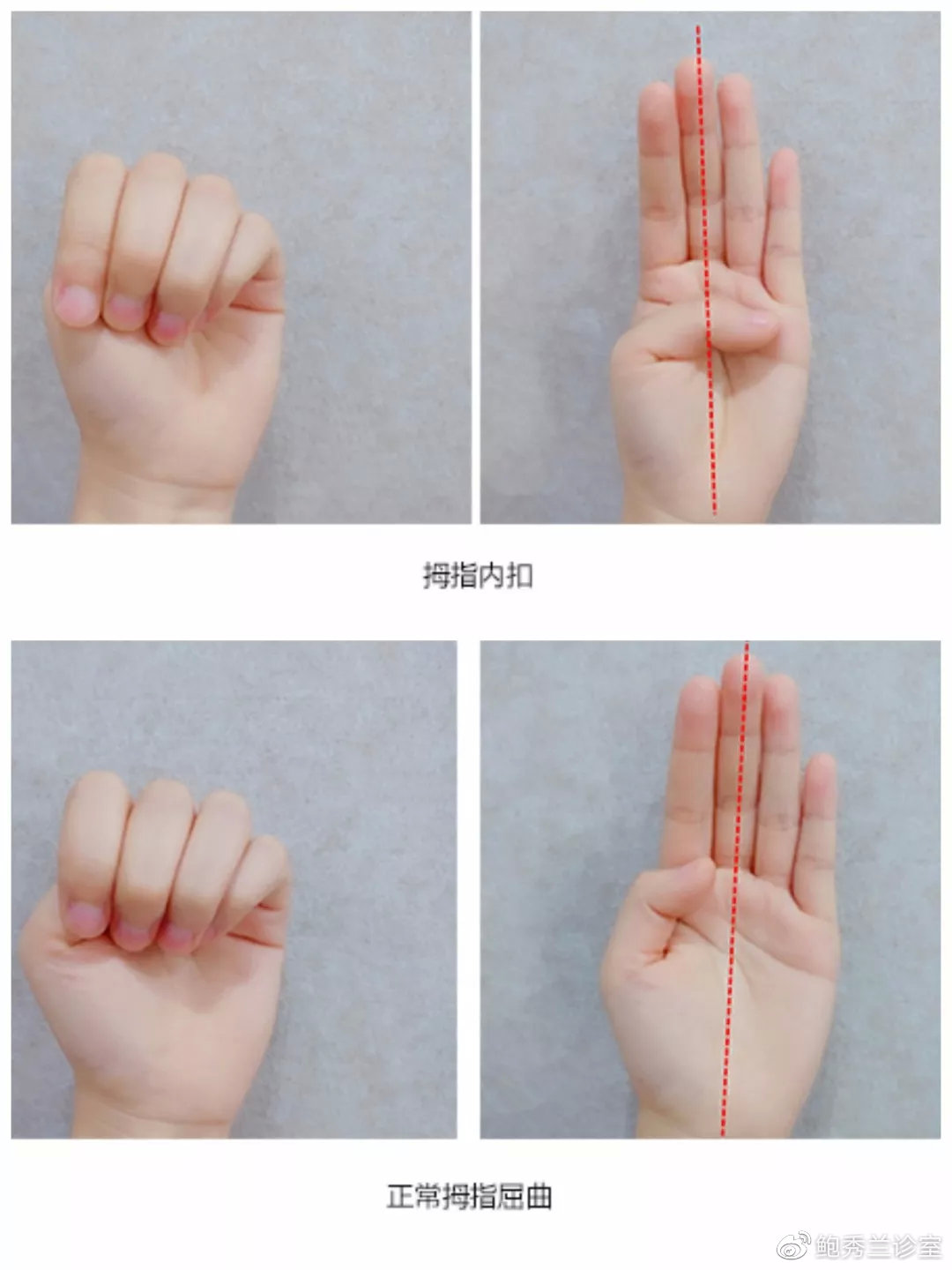 握拳拇指弯曲就是拇指内扣?答案和你想的不一样,家长别再焦虑了
