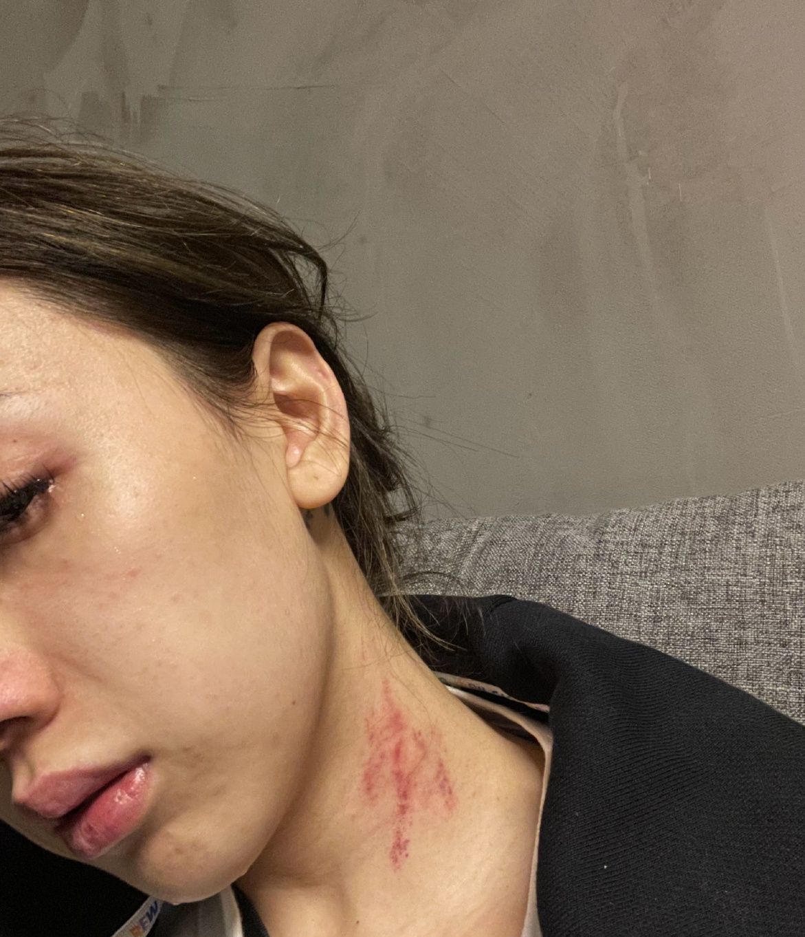 女歌手控诉前任,多次遭他家暴致耳膜穿孔,受伤照里脖子都是抓痕