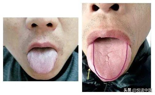 看到这类舌象,小心肝和脾出问题|李东垣|舌诊十讲|脾胃_新浪新闻