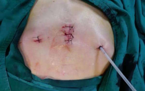乳腺导管瘤术后照片图片