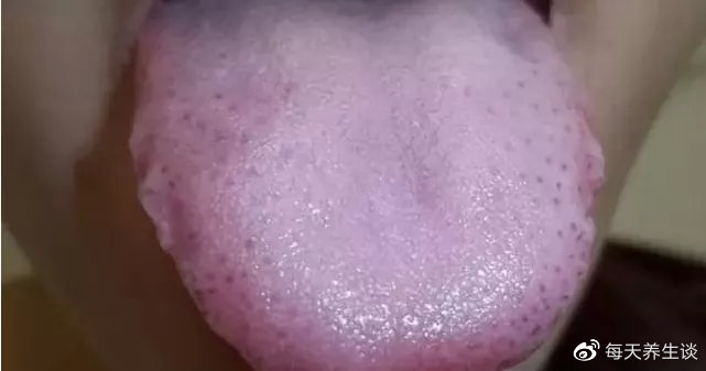 恶心,腹胀不舒服的情况,可以先对照着镜子,看看自己的舌头是不是胖大