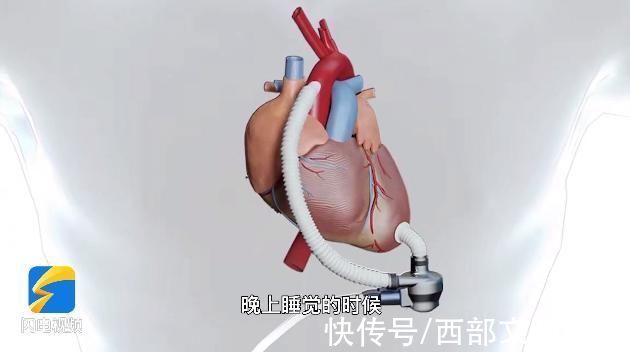 每天要充电!山东首例人工心脏植入患者出院，网友:像科幻电影休闲区蓝鸢梦想 - Www.slyday.coM