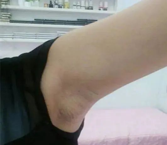 过去很困难,久而久之,这些地方都容易鼓出来包,尤其是腋窝和腘窝处