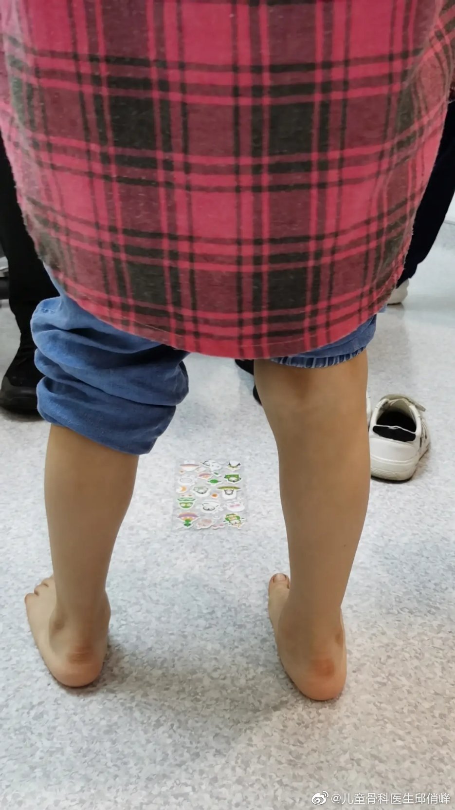 "医生,我家孩子大脚趾向外撇,能手术吗