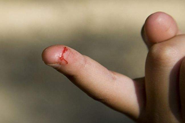 手指受伤能用唾液消毒吗