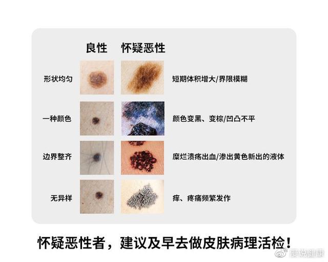 4种痣,劝你能及时发现