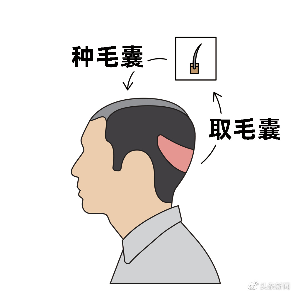 那些植发的人最后都头发茂密了吗
