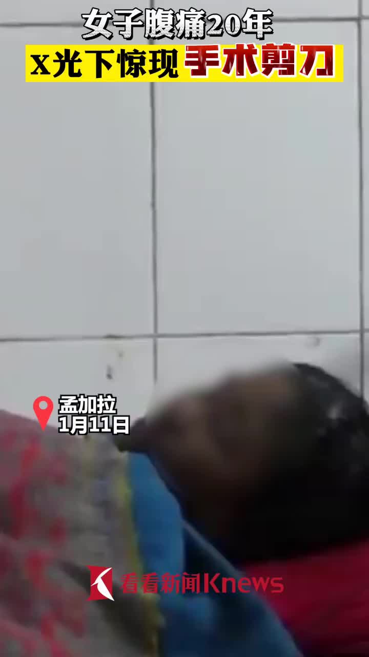 孟加拉女子腹痛年x光下惊现 古董手术剪刀