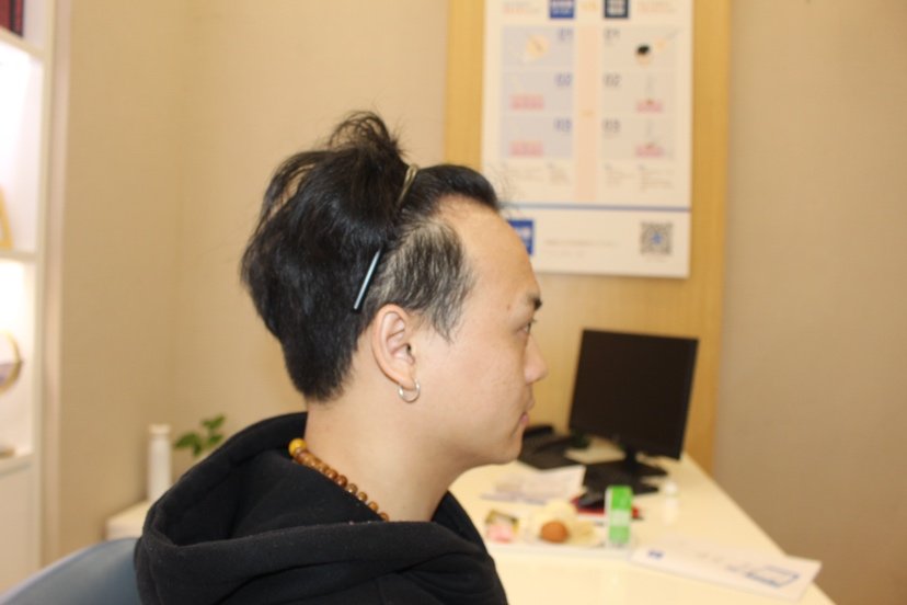 植发现在已经8个多月了,种植的头发长得特别好,已经长得很长了