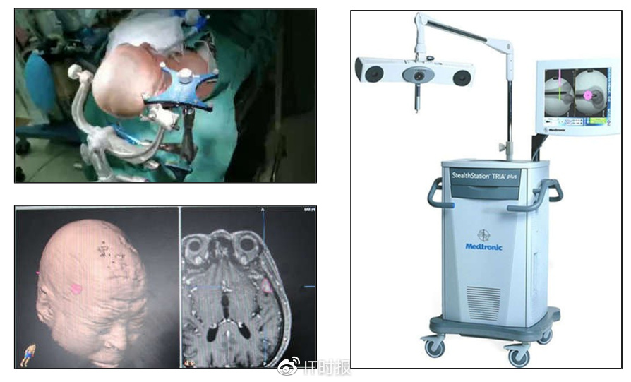 神经外科手术发展现状 中国外科微创技术历程