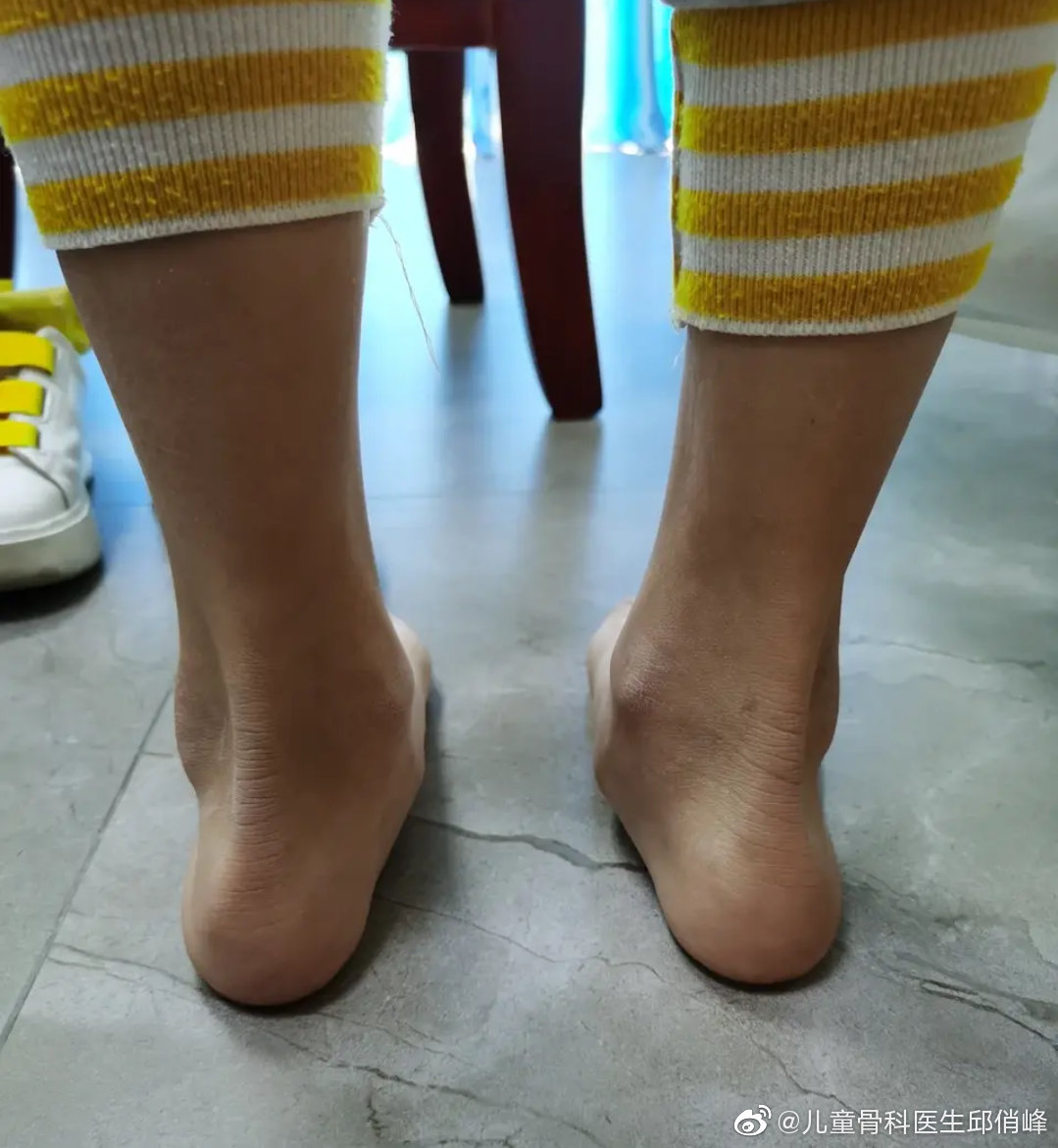 副舟骨症,足外翻的一种,通过副舟骨去除,韧带重建