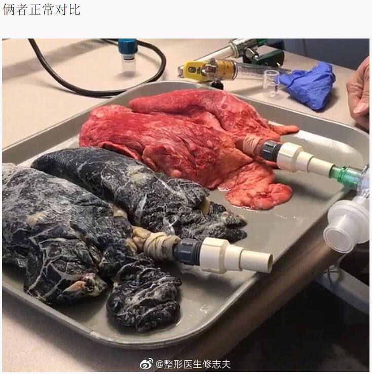 健康的肺和吸烟者的肺 转给你身边抽烟的人看看._高清图集_新浪网