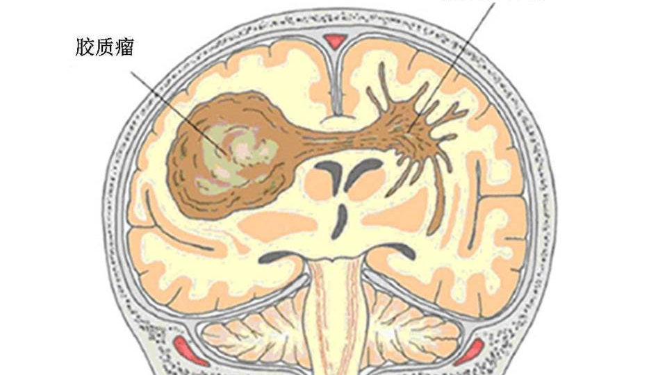 胶质瘤治愈率?脑胶质瘤能活多久?|脑瘤|胶质瘤|手术_新浪新闻