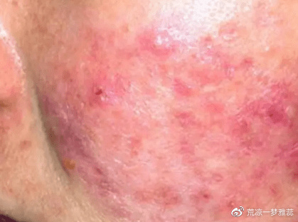 湿疹皮炎之间有什么不同点?