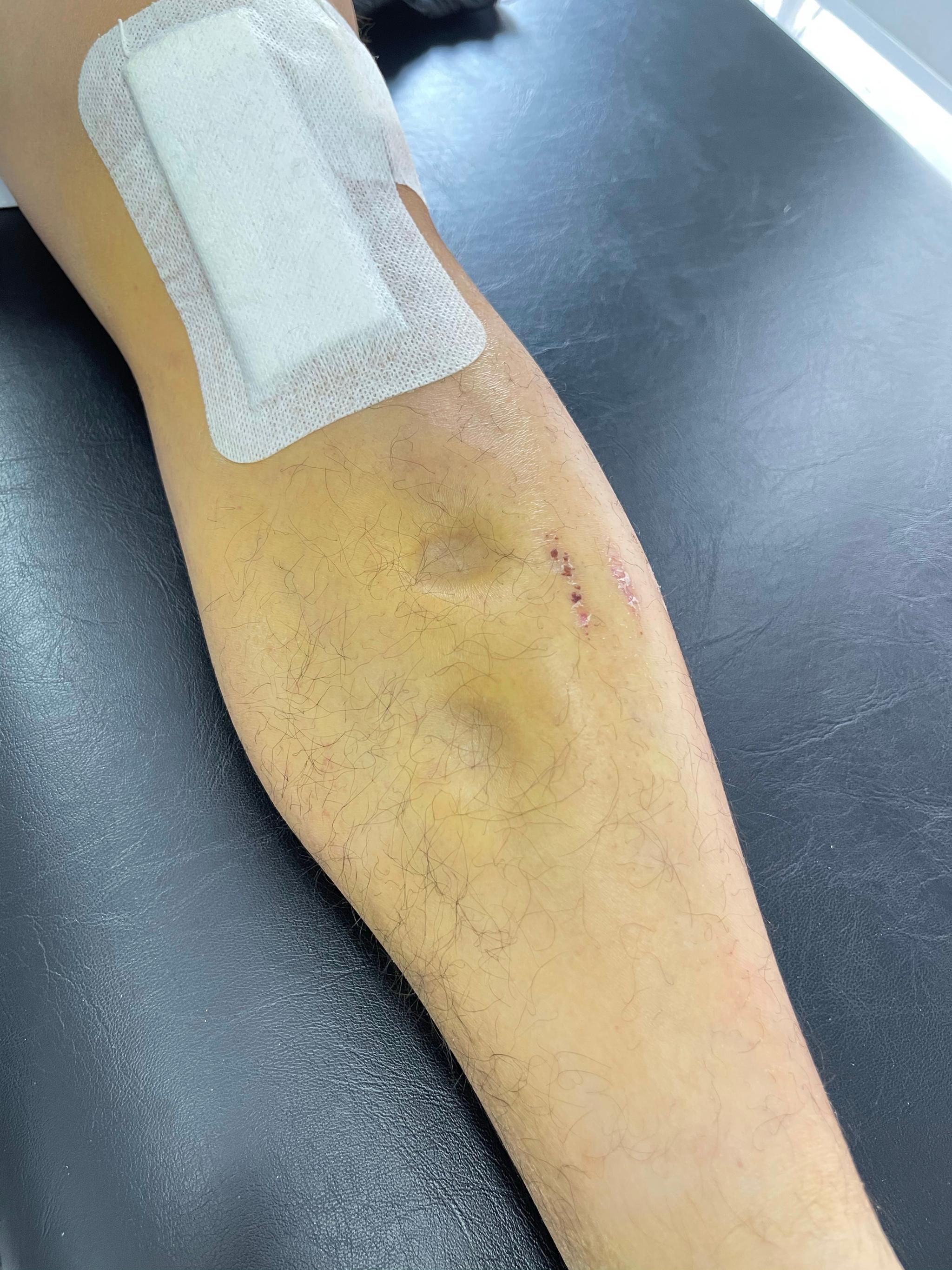 反面教材: 术后踝泵做的不够,出现比较严重的凹陷性水肿