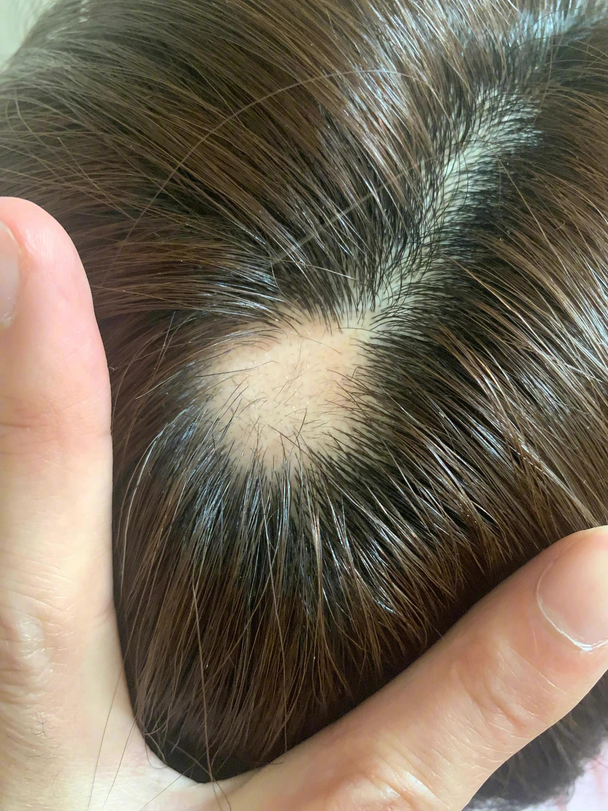 沈梦辰微博发布了一张自己头顶上斑秃的图片